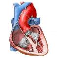 Mitral Valve Surgery