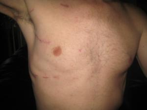 Heart Surgery Scar 5 weeks