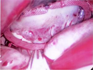 Mitral Valve Prolapse Picture - After